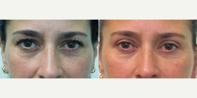 45-54 year old woman treated with Eyelid Surgery - This woman of Mediterranean descent presented with the complaint of heaviness over her eyelids. She stated that she was having difficulty applying eyeliner, eye shadow, and mascara. Evaluation demonstrated significant excess of thin upper eyelid skin, along with adequately positioned eyebrows. We agreed to perform an upper eyelid lift (blepharoplasty) under local anesthesia and mild oral sedation in our Center. Her results demonstrate significant improvement in her eyelid show and heaviness. She stated that make-up application is much easier due to the decrease in excess tissue above her lids. The sutures were removed after 6 days and she returned to work the next day.