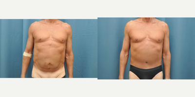 65-74 year old man treated with Male Tummy Tuck - 65-74 year old man treated with Male Tummy Tuck