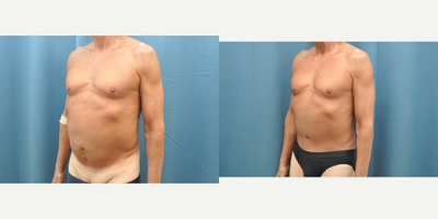 65-74 year old man treated with Male Tummy Tuck - 65-74 year old man treated with Male Tummy Tuck