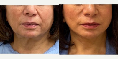 69 yo s/p Deep Plane Face and Neck lift performed under local anesthesia with sedation in our on site AAAA certified operating s - 69 yo s/p Deep Plane Face and Neck lift performed under local anesthesia with sedation in our on site AAAA certified operating suite