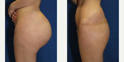 25-34 year old woman treated with Silicone Injection Removal - Meet our patient, a 30-year-old white female standing at 5'5 and weighing 160 pounds. In 2018, she had silicone injections into her buttocks in New York City, which resulted in numerous issues and complications.In search of a solution, she consulted with the exceptional Dr. J. Timothy Katzen in Beverly Hills, CA, who suggested silicone removal in her buttocks and a posterior body lift for silicone removal. The procedures went smoothly and were successful in removing the silicone and improving the appearance and health of her buttocks.We are delighted to hear that the patient is much happier and healthier after her surgeries. It's inspiring to see how cosmetic procedures can not just enhance one's appearance but also improve their overall well-being and quality of life.We wish her continued health and happiness and applaud her for taking the necessary steps towards achieving her goals.