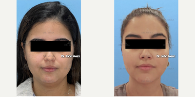 25-34 year old woman treated with Extended Chin Liposuction, NeckTite, Mini FaceTite, Morpheus8 - 25-34 year old woman treated with Extended Chin Liposuction, NeckTite, Mini FaceTite, Morpheus8