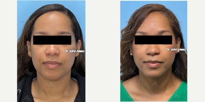35-44 year old woman treated with Extended Chin Liposuction, NeckTite, Mini FaceTite, Morpheus 8 - 35-44 year old woman treated with Extended Chin Liposuction, NeckTite, Mini FaceTite, Morpheus 8, After Failed Kybella elsewhere