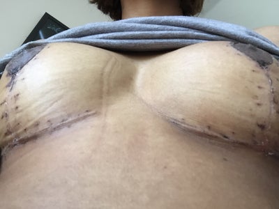 21 Years Old - 32DDD to 32B Breast Reduction - Boulder, CO 