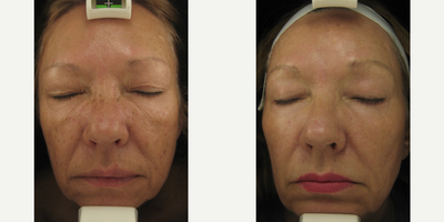 55-64 year old woman treated with ProFractional Laser - Profractional