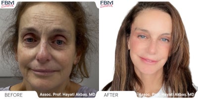 55-64 year old woman treated with Deep Plane Facelift, Facelift, Neck Lift, Rhinoplasty, Facial Fat Transfer, Eyelid Surgery - 55-64 year old woman treated with Deep Plane Facelift, Facelift, Neck Lift, Rhinoplasty, Facial Fat Transfer, Eyelid Surgery