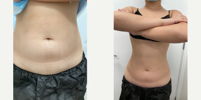 Woman treated with truSculpt iD, truSculpt flex - Female 20s, TruSculpt iD x 1 and TruSculpt flex x 6