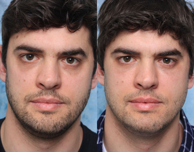 25-34 year old man treated with Hyaluronidase - 33 year old man unsatisfactory lower eyelid surgeryDiagosis:1. Lower eyelid fat over-resection2. Hyaluronic acid overfill3. Under eye hollowTreatment: Hyaluronidse to remove the improperly placed hyaluronic acid filler. Placement of hyaluronic acid in the hollow under eye.