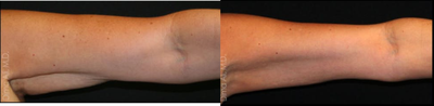45-54 year old woman treated with Venus Freeze - At WellMedica, we provide Venus Freeze treatments for the arms. Venus Freeze is suitable for various face and body applications including circumference reduction, cellulite improvement, skin tightening and wrinkle reduction. Treatments are safe, quick and effective for all skin types.