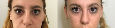25-34 year old woman treated with Restylane  - This Patient came to us wanting to improve her under eye circles / Darkness. Dr. Rivkin used Restylane Refyne - a very gentle filler that is specifically able to target fine lines and raise the skin beneath her eyes to decrease the appearance of her under eye bags.