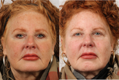 55-64 year old woman treated with LaseMD - This patient had one LaseMD treatment. This laser treatment was able to reduce her pigmentation and sun damage.