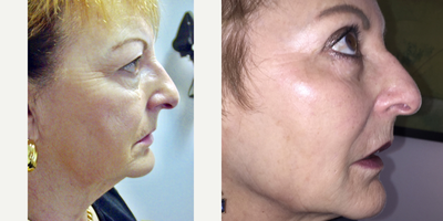 65-74 year old woman treated with Dermapen - Patient had upper lid blepharoplasty and multiple treatments of microneedling ,Juvederm and pelleve.