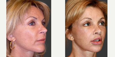 55-64 year old woman treated with Facelift Revision - This patient underwent a facelift revision, a lip lift, a lower lip V-Y plasty, an endoscopic browlift and a lower blepharoplasty