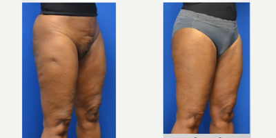 55-64 year old woman treated with Renuva, Morpheus8 - 3cc Renuva to the right thighMorpheus 8 to the circumferential thighs