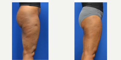 55-64 year old woman treated with Renuva, Morpheus8 - 3cc Renuva to the right thighMorpheus 8 to the circumferential thighs