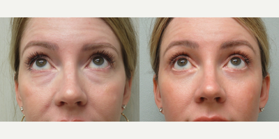 35-44 year old woman treated with Brow Lift, Eyelid Surgery - This patient underwent an endoscopic browlift with a hairline incision and a Quad Blepharoplasty to rejuvenate her upper and lower lids.