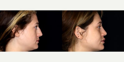 29 year old woman treated with Rhinoplasty, Voluma, Juvederm - 29 year old woman treated with rhinoplasty, 1 syringe of Voluma to cheeks, 1.5 syringe of Juvederm Ultra CX to lips and 0.5 syringe of Juvederm Ultra XC to nasalabial folds. Photos depict before and 3 months after treatment.