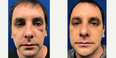 35-44 year old man treated with Cyst Removal - Excision in combination with Venus Viva laser treatment to eliminate this man's cyst on his face.