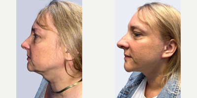 Woman treated with Mini Facelift - Check this out! A mini facelift before and after results! A mini facelift targets specific areas of concern, such as the lower face and neck, to address signs of aging, such as sagging skin and jowls. This procedure results in a shorter recovery time and minimal scarring compared to a traditional facelift. It provides a more subtle and natural-looking enhancement, making it a popular choice for individuals seeking a refreshed appearance with less downtime!