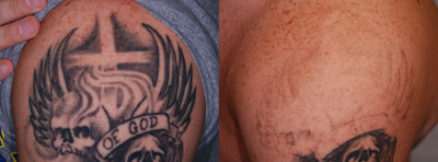 PicoWay - Photos provided courtesy of Syneron, performed by Eric F. Bernstein, MD