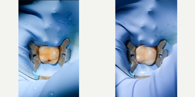 18-24 year old woman treated with Dental Bonding - Composite bonding. Cavity remotion and composite bonding.