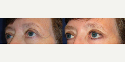 55-64 year old woman treated with Eyelid Surgery - This patient had an upper eyelid lift (upper blepharoplasty) performed under local anesthesia in less than an hour.