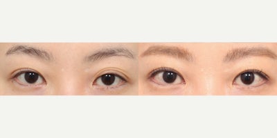 35-44 year old woman treated with Double Eyelid Surgery, Eyelid Surgery, Canthoplasty - She had non-incisional eyelid/double eyelid with ptosis correction (revision), lateral canthoplasty, lower lateral canthoplasty