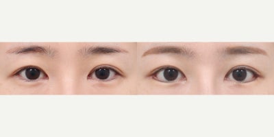 25-34 year old woman treated with Canthoplasty - She had lateral canthoplasty, lower lateral canthoplasty