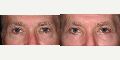 45-54 year old man treated with Eyelid Surgery, Fractional Laser - This gentleman underwent upper and lower lid blepharoplasty along with laser resurfacing to the lower lids to improve the overall skin tone, texture and fullness of the eyelids.