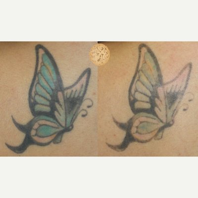 25-34 year old woman treated with Tattoo Removal - Results after just one treatment in darker skinned individual.