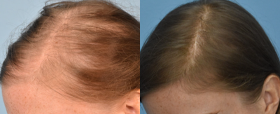 35-44 year old woman treated with Hair Loss Treatment - 35-44 year old woman treated with Hair Loss Treatment