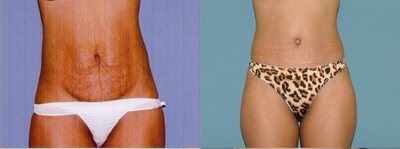 Tummy Tuck - 
	This is a 43 year old female who had significant muscle weakness and excess skin present after pregnancy. We decided on a full tummy tuck with tightening of the muscles and removal of excess skin.&nbsp;
