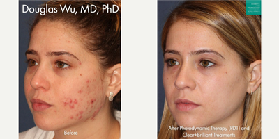 18-24 year old woman treated with Photodynamic Therapy - Photodynamic therapy with Clear+Brilliant to treat active acne in a female patient.