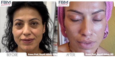 55-64 year old woman treated with Deep Plane Facelift, Canthoplasty - 55-64 year old man treated with Deep Plane Facelift