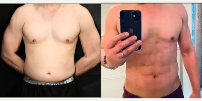 35-44 year old man treated with Abdominal Etching - 43year-old man treated with Abdominal EtchingHeight: 55 Weight: 132.6 pounds BMI: 22.06Goals: Wanted a flat and defined stomachTime After Surgery: 2 weeks