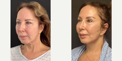 Woman treated with Laser Resurfacing - Woman treated with Deep Plane Facelift, Neck Lift, Brow Lift, and CO2 Laser Resurfacing. Post-op, she had jawline and neck definition as well as youthful-looking brows.