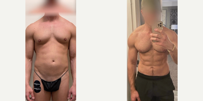 Man treated with Liposuction, Bellafill - Man treated with Liposuction, Bellafill