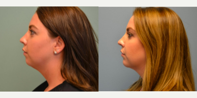 25-34 year old woman treated with Kybella - Treated with 2 vials of Kybella 6 weeks apart.