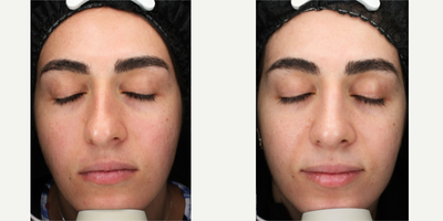 18-24 year old woman treated with Secret RF - 18-24 year old woman treated with Secret RF