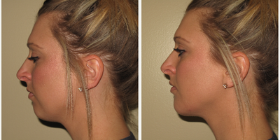 25-34 year old woman treated with Bellafill - Bellafill placed in chin
