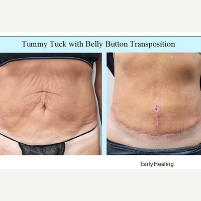45-54 year old woman treated with Meaningful Beauty, SlimLipo - Tummy Tuck performed only with Local Tumescent Anesthesia allows for a quick recovery with minimal downtime.Bellow you will find a few examples.