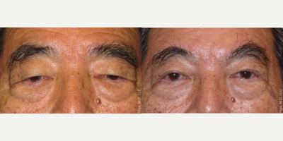 65-74 year old man treated with Asian Eyelid Surgery - Most older men are not looking for perfect asian lids, but rather eyelids which appear natural and close naturally.