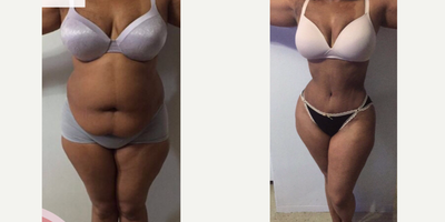 35-44 year old woman treated with Tummy Tuck - 35-44 year old woman treated with Tummy Tuck
