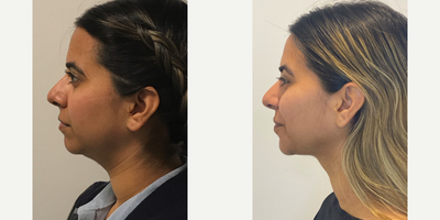 Woman treated with Smart Lipo - Woman treated with Smart Lipo