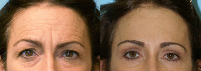 Forehead Lift - 	This patient wanted to refresh the upper third of her face. She had an endoscopic browlift, upper eyelid surgery and lower eyelid surgery. The result is a natural, rejuvenated look.