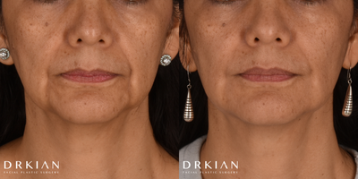 Revanesse Versa for Nasolabial Folds & Perioral Rhytids - Before & After Revanesse Versa Injections for Smile Lines and Jowls.