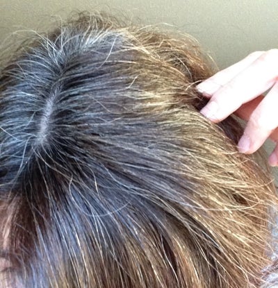 Does regrowth after telogen effluvium typically appear finer and ...