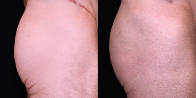 25-34 year old male treated with Nonsurgical Butt Lift - non-surgical butt lift