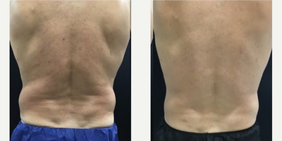 45-54 year old man treated with CoolSculpting, truSculpt iD - Coolsculpting combined with Trusculpt iD for fat reduction and skin tightening of flanks.