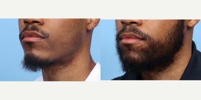 25-34 year old man treated with Beard Transplant, Hair Transplant, Hair Loss Treatment, PRP Injections, PRP for Hair Loss - This patient wanted to fill in the sparse area of hair around his lips. Dr. Wise performed an FUE hair transplant, placing 2,550 grafts to the beard area giving the patient the results he desired.